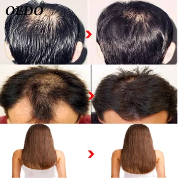 Marokas Vaistažolių Ženšenio Plaukų Priežiūros Esmė Gydymo Vyrų Ir Moterų Plaukų Slinkimas, Greitas, Galingas Plaukų Augimo Serumas Remonto root